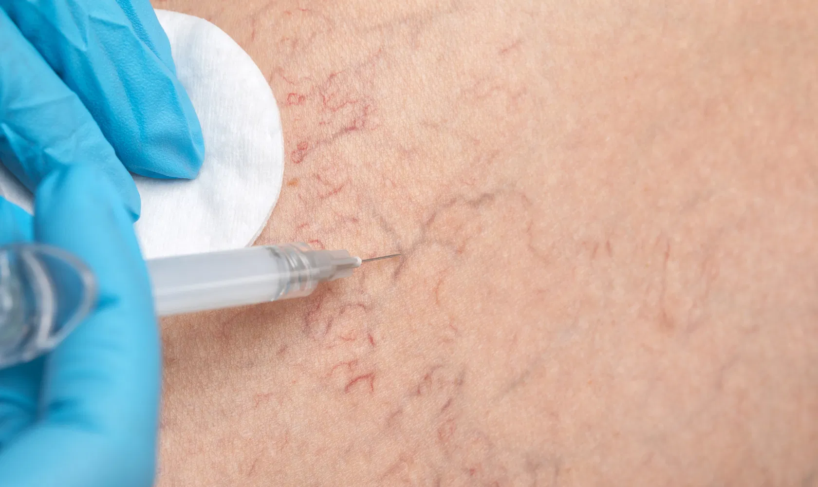 A gloved hand at a Cooper City med spa injects a needle into skin showing visible spider veins, with a cotton pad placed nearby for the procedure.